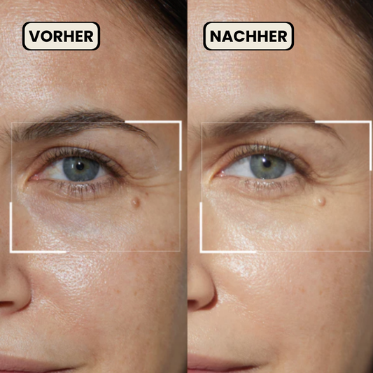 LumiLift Eye Therapy